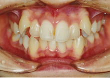 叢生・八重歯・歯並びがでこぼこ
