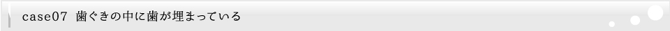 歯ぐきの中に歯が埋まっている